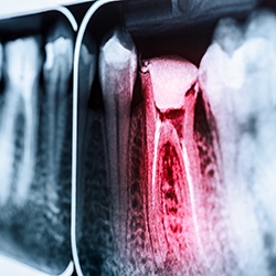 Root canal treatment can cost different depending on the location of the affected tooth