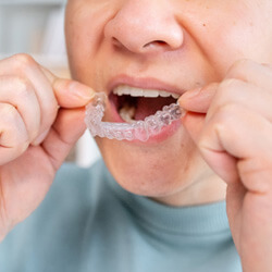 patient putting clear aligner on bottom teeth