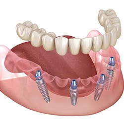 All-on-4 dentures