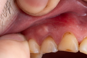 Close-up of man pulling up lip to show bump on gums